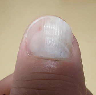 조갑박리증 증상과 중장년 손톱 건강 관리
